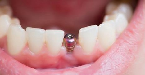 Implant dentaire Tunisie