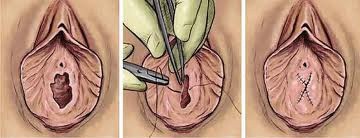 hymenoplastie-tunisie