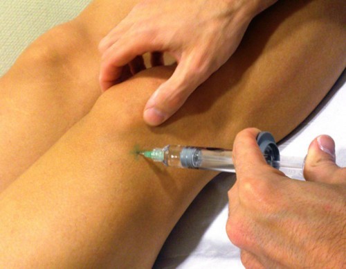 L’arthrose, un handicap surmontable grâce à l’acide hyaluronique !