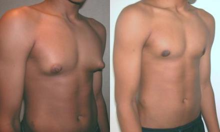 gynecomastie-en-tunisie
