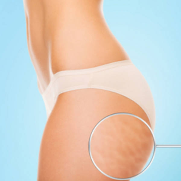 traitement cellulite