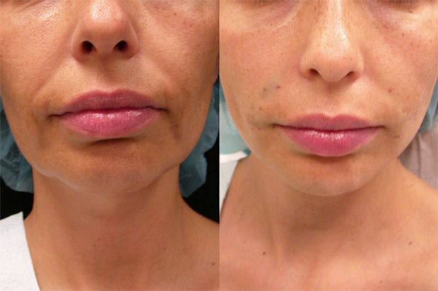 Microneedling et Morpheus8 : nouveaux traitements anti-âge