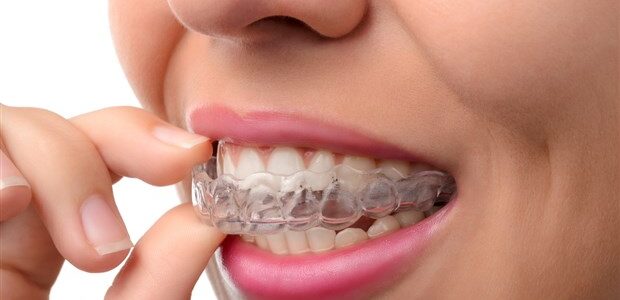 Les appareils orthodontiques Invisalign