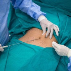 refus chirurgien liposuccion