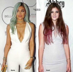 kylie jenner avant apres