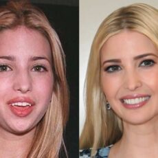 ivanka trump chirurgie esthetique