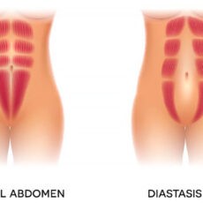 traitement diastasis recti