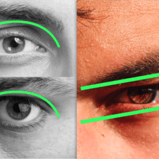 hunter eyes chirurgie