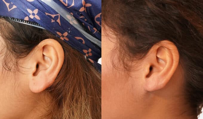 chirurgie lobe oreille tunisie