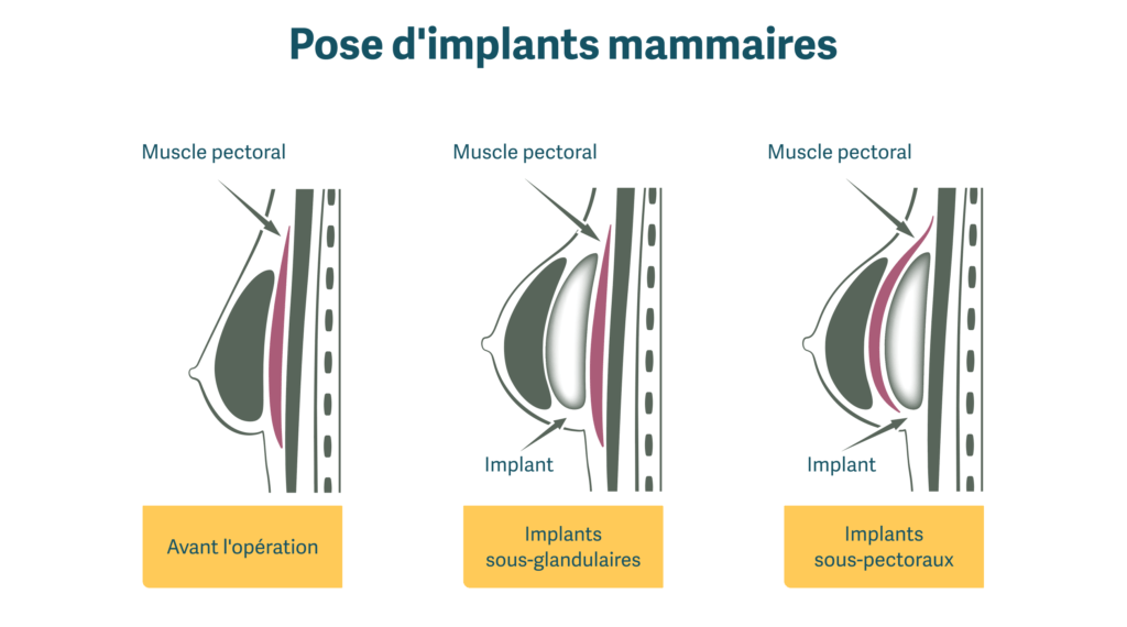 emplacement implant mammaire