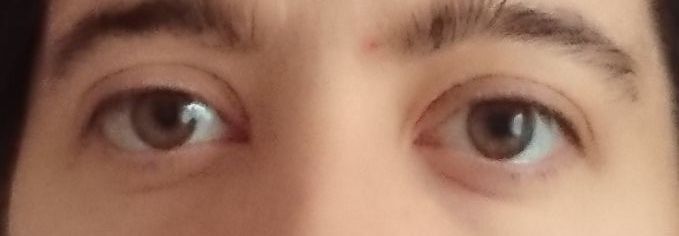 yeux globuleux