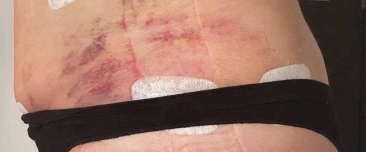 Traitement fibrose après liposuccion