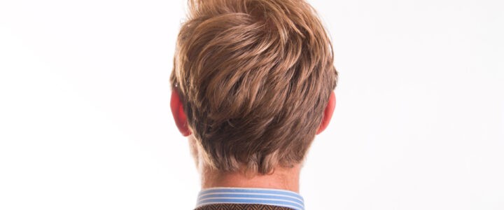 deuxieme greffe cheveux