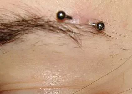 enlever piercing par laser