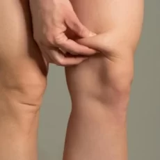 liposuccion-genoux