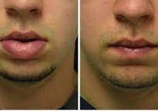 réduction des lèvres avant apres