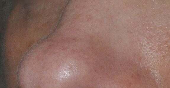 rhinoplastie nez bifide fossette