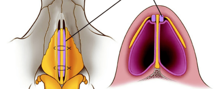 rhinoplastie par greffe de côtes