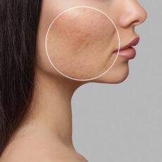 traitement cicatrice acne