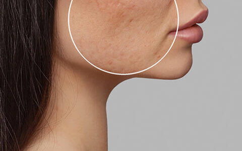 traitement cicatrice acne