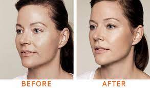 juvederm volite