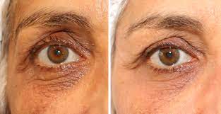 veines sous yeux