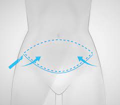 Ventre insensible après une abdominoplastie