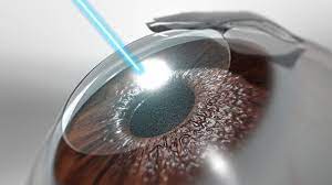 lasik temps pour bien voir
