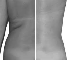Traitement du pli soutien gorge par cryolipolyse