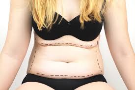 Quelles sont les alternatives de l’abdominoplastie ?