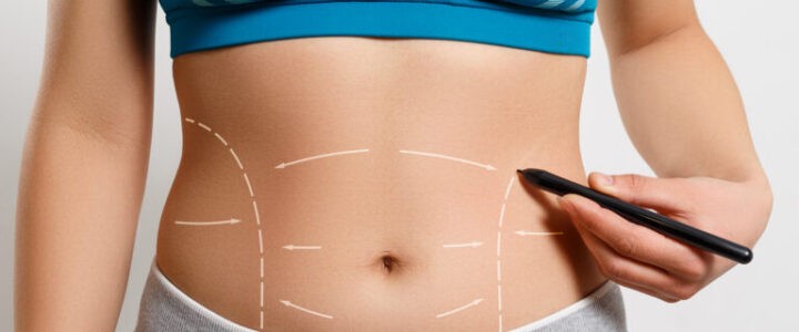 retractation peau apres liposuccion