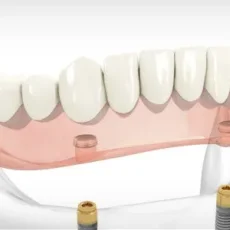 Le guide complet des prothèses amovibles sur implants