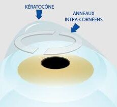 Anneaux Intracornéens