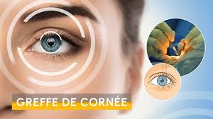 greffe cornee tunisie