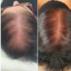 LED pour chute des cheveux : luminothérapie