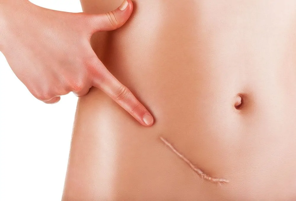 correction des cicatrices par RF