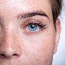 Kératopigmentation (KTP ) vs. Kératopigmentation Annulaire Esthétique (KAE)