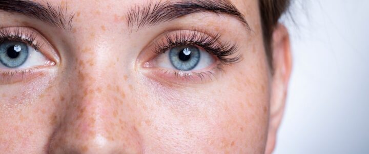 Kératopigmentation (KTP ) vs. Kératopigmentation Annulaire Esthétique (KAE)