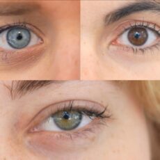 Kératopigmentation au Canada