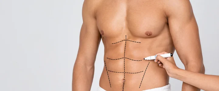 Abdominal Etching Ugraft (par Ultrasons)