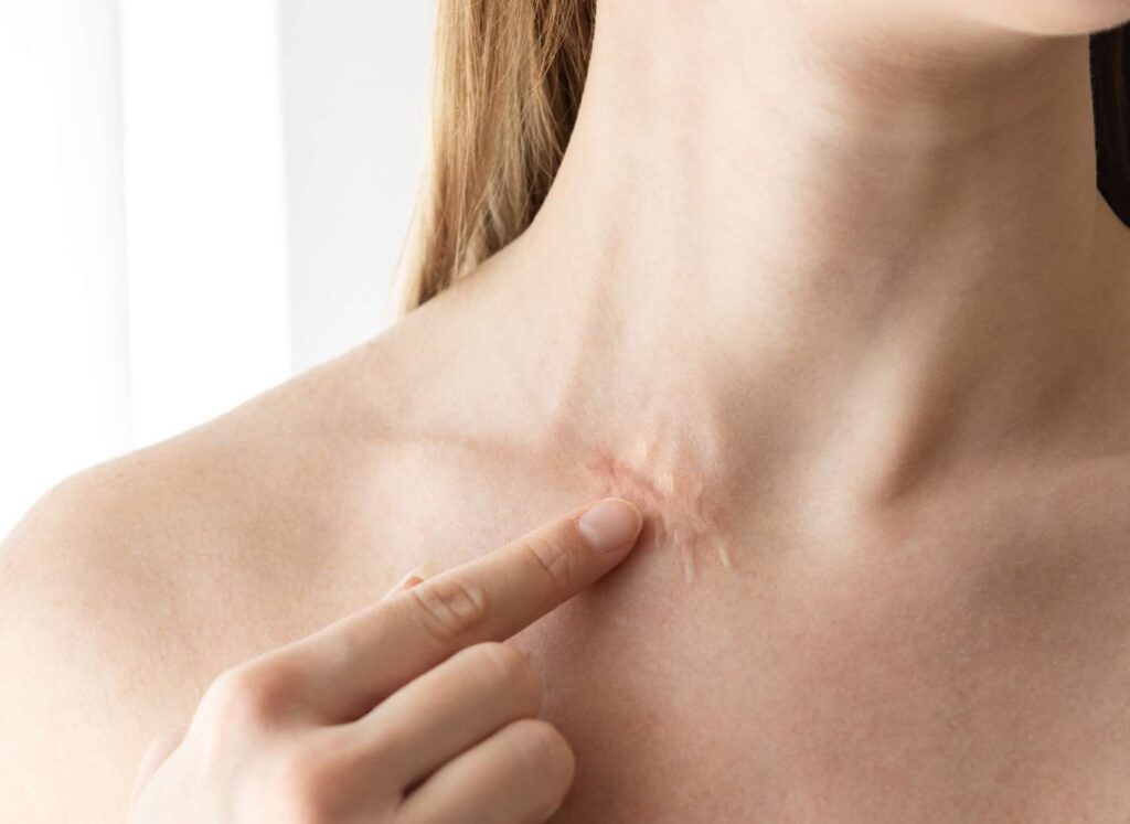 derme artificiel pour brulure