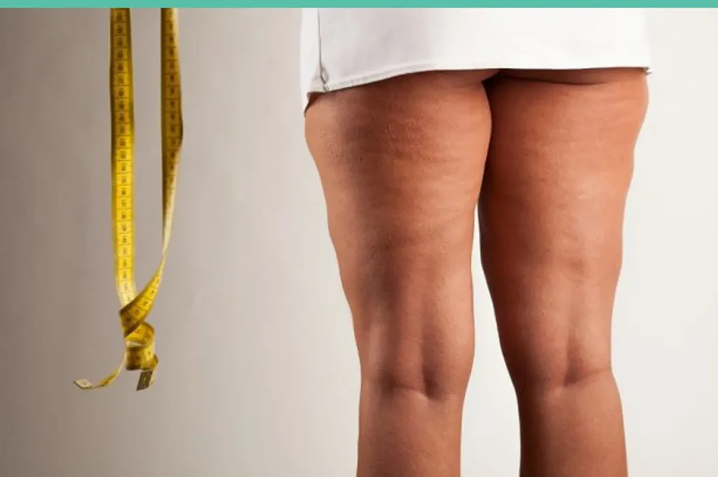 j plasma fausse solution au lipoedeme