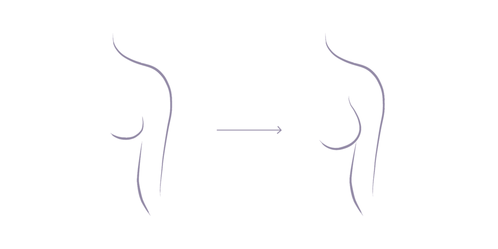 hybrid breast augmentation