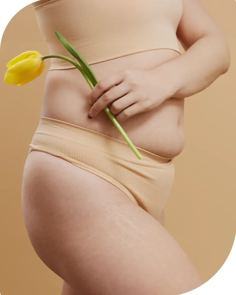 lipœdème abdominal