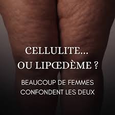 lipoedeme ou cellulite