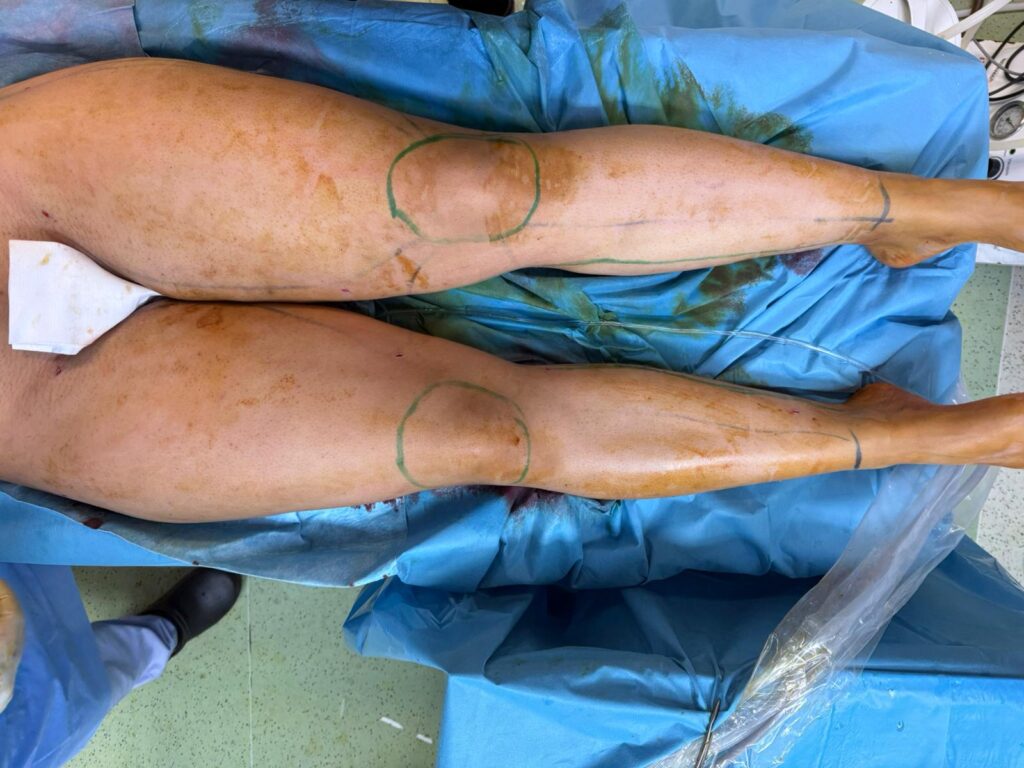 lipoedeme vs 4d lipo