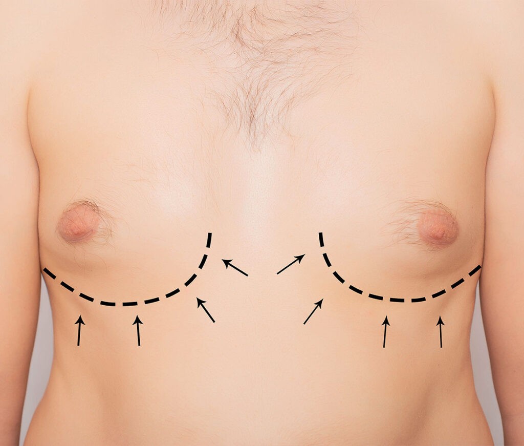 traitement gynecomastie par renuvion