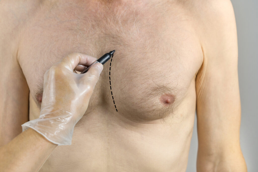 nipple reduction vs gynecomastie